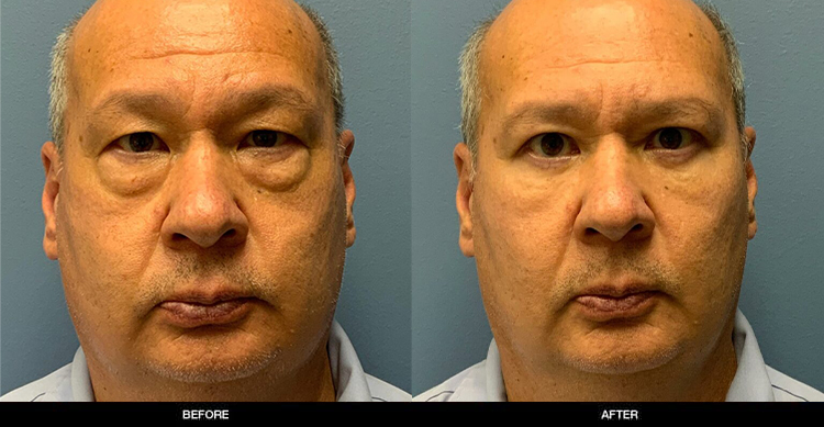 MALE-Eyelid Lift