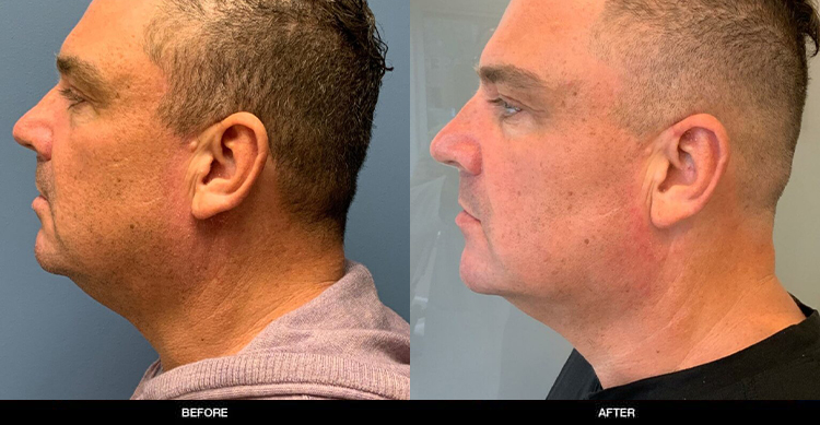 MALE Neck Lift