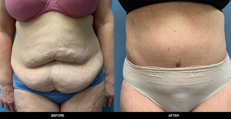 Tummy Tuck