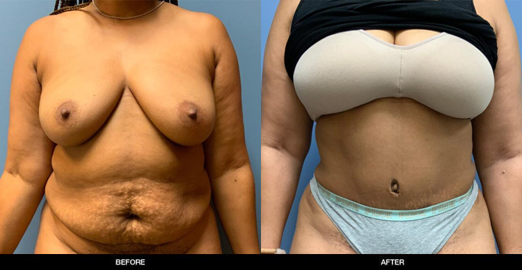 Tummy Tuck2
