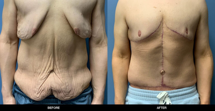 Tummy Tuck3